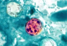 US Cyclosporiasis Outbreak: What To Know About The ‘Explosive Diarrhoea’ Parasite